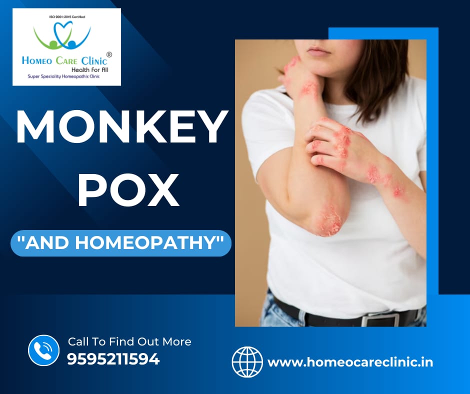 monkeypox symptoms and its homeopathic Treatments