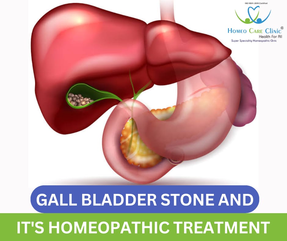 Gall Bladder Stone homeopathic treatment