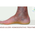 Venous Ulcer Homeopathic Treatment