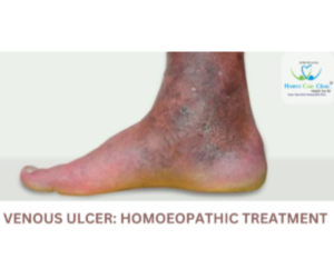 Venous Ulcer Homeopathic Treatment