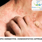 Eczema natural treatment homeopathy