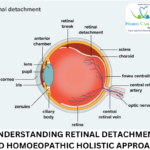 Diagram of retinal detachment showing types and causes