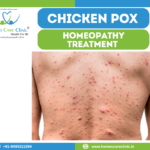 Homeopathic Treatment for Chickenpox