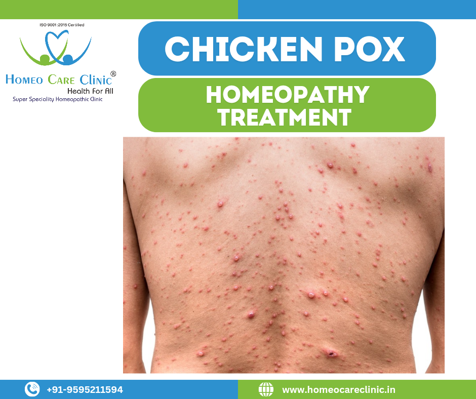 Homeopathic Treatment for Chickenpox