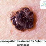 homeopathic treatments for seborrheic keratosis