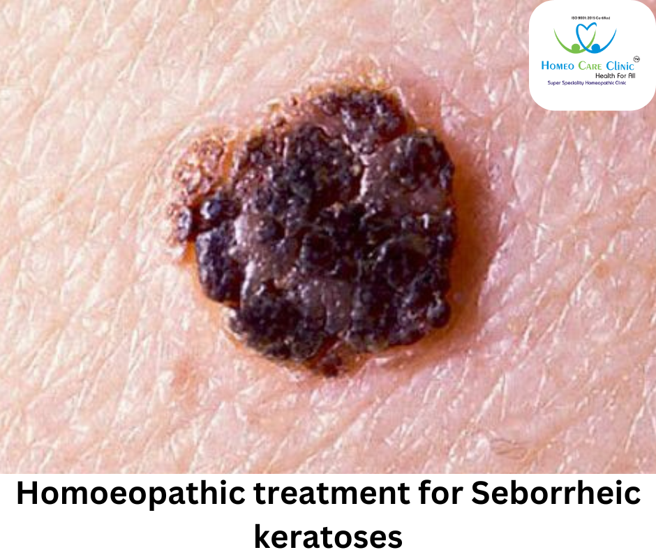 homeopathic treatments for seborrheic keratosis