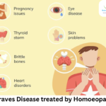 Homeopathy remedies for Graves