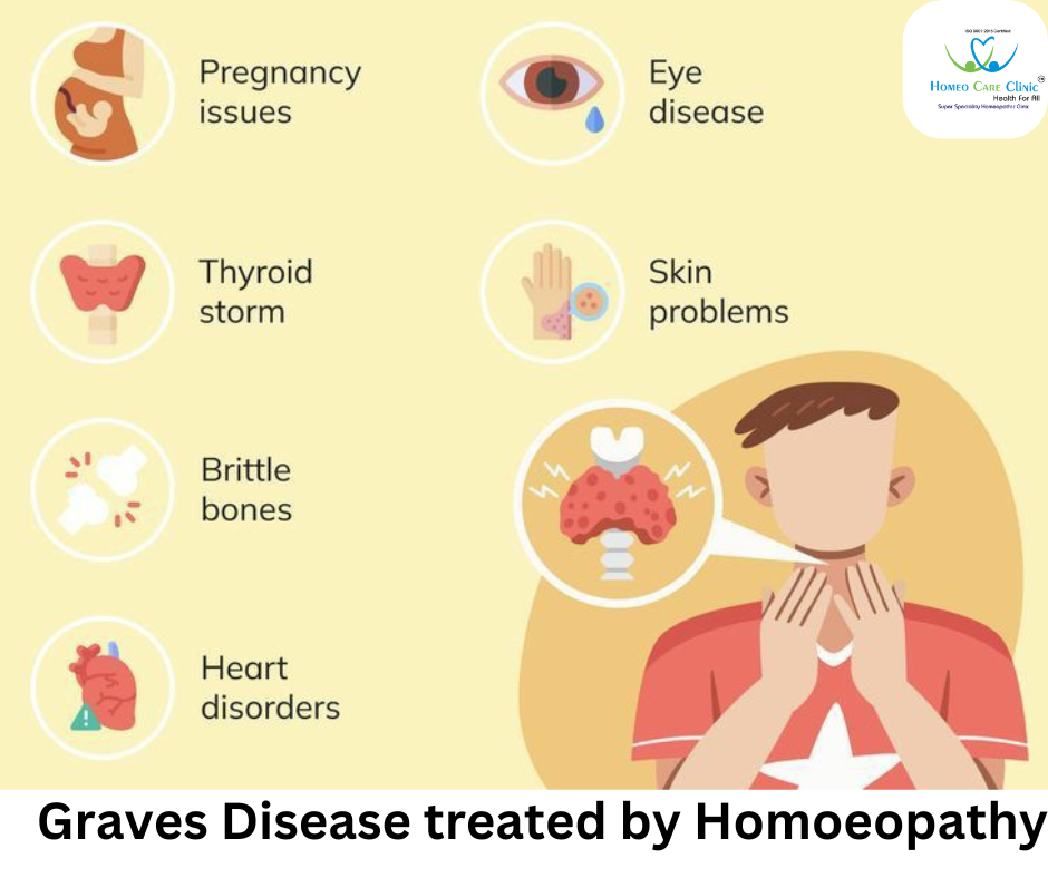 Homeopathy remedies for Graves