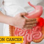 Homeopathic medicine for colon cancer