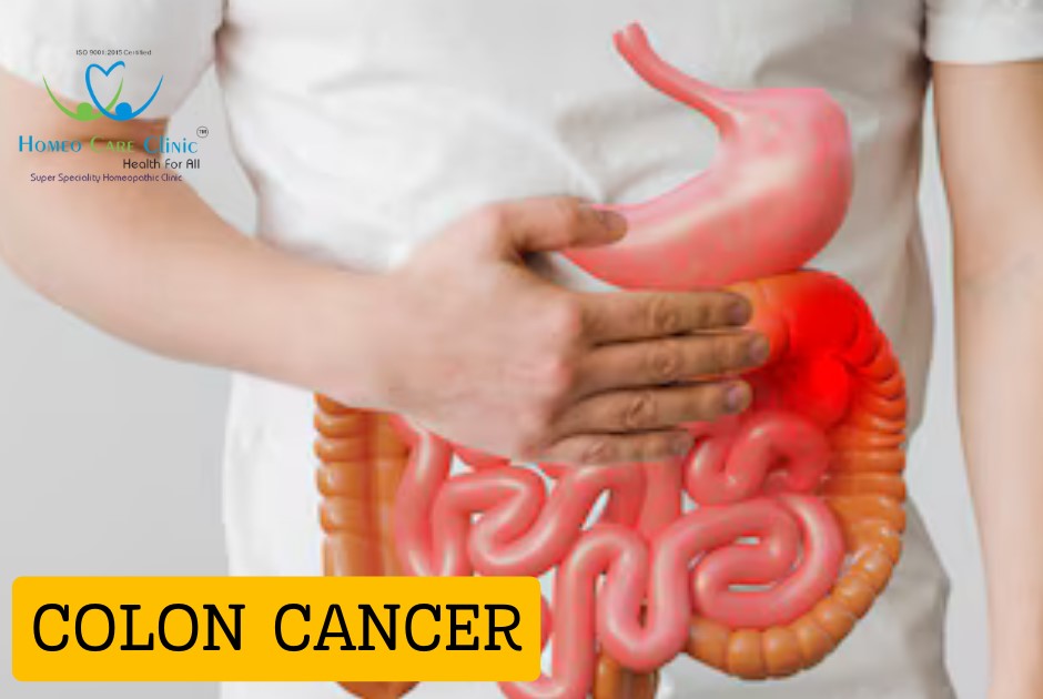 Homeopathic medicine for colon cancer