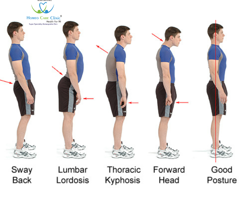 Types of lumber Lordosis 