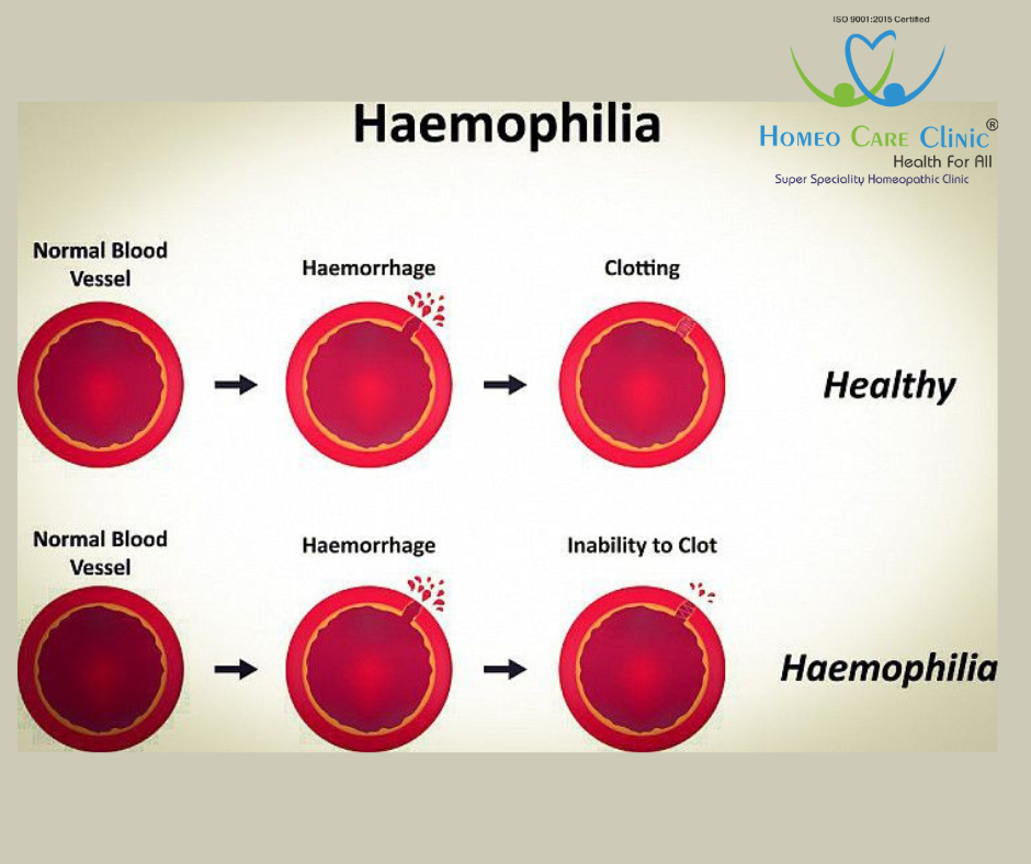 Haemophilia A and Haemophilia B