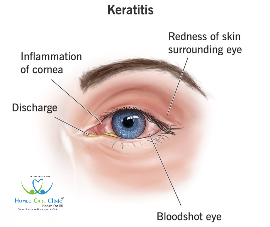 Homeopathic Treatment for Acute Keratitis