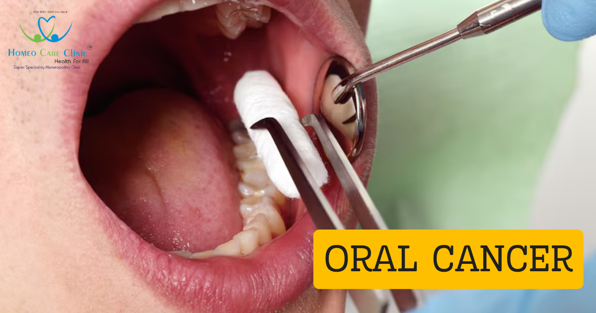 Homeopathy Oral Cancer Treatment