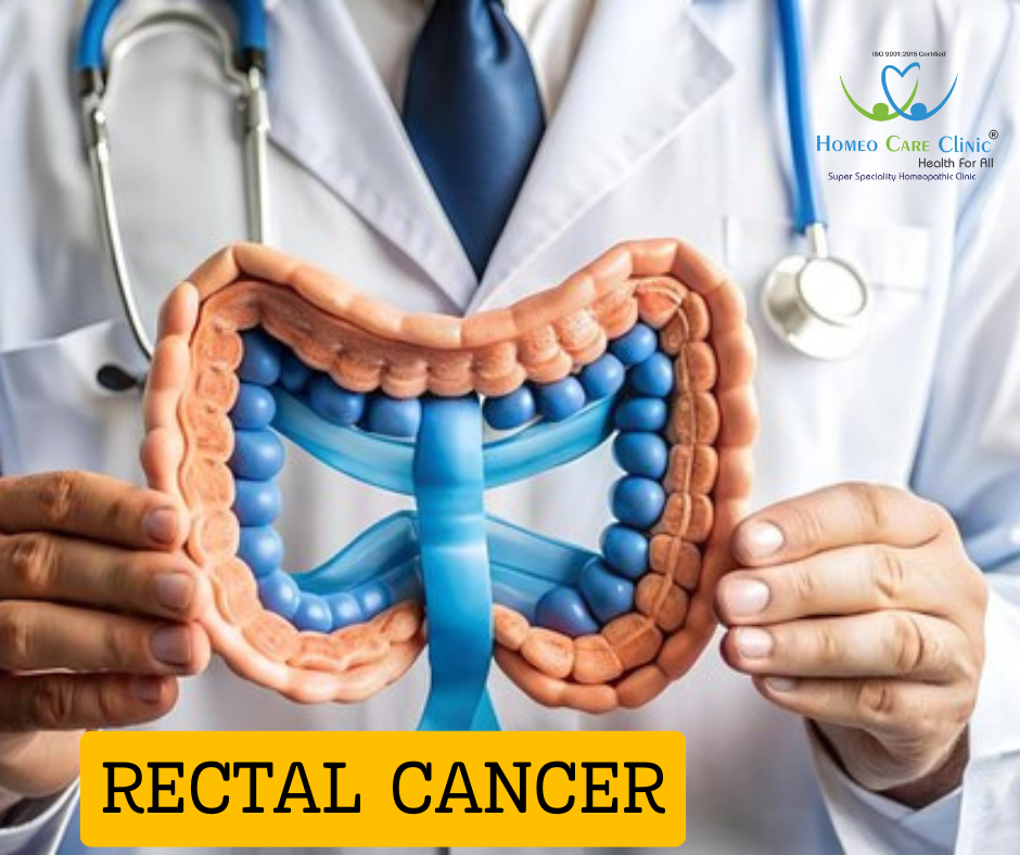 Homeopathic Rectal Cancer Treatment