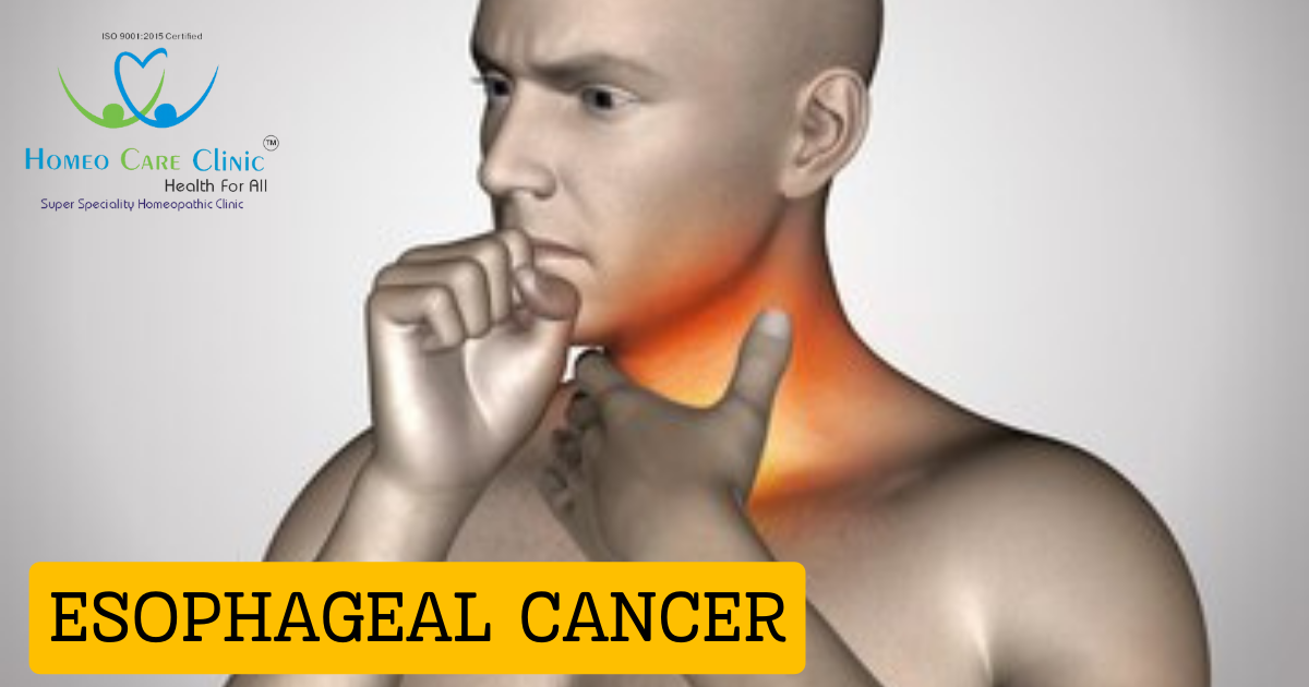 Esophageal Cancer Homeopathic Treatment