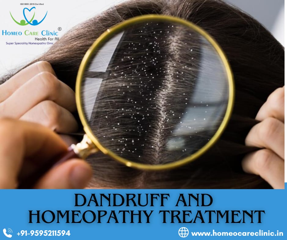 Dandruff: Types, Causes, Symptoms