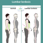 lumbar Lordosis Treatment