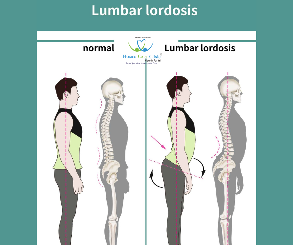 lumbar Lordosis Treatment