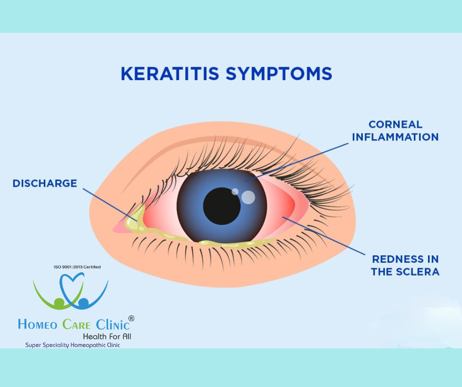 Symptoms of Acute Keratitis