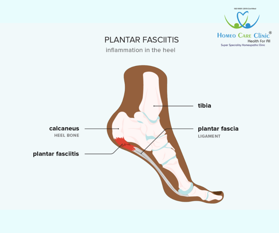 plantar fasciitis,