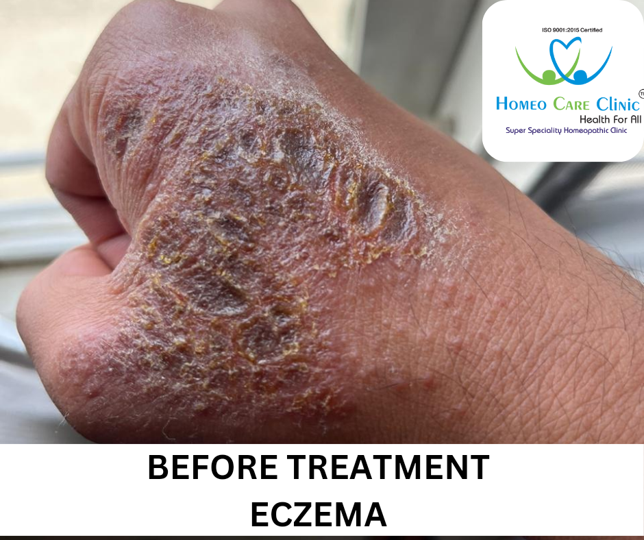 eczema homeopathy treatment