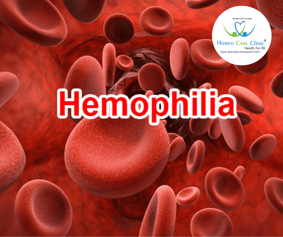 Homeopathic Treatment of Haemophilia