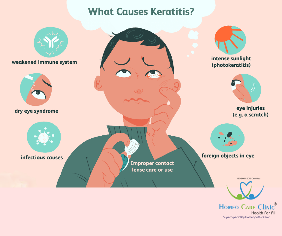 Causes of Acute Keratitis