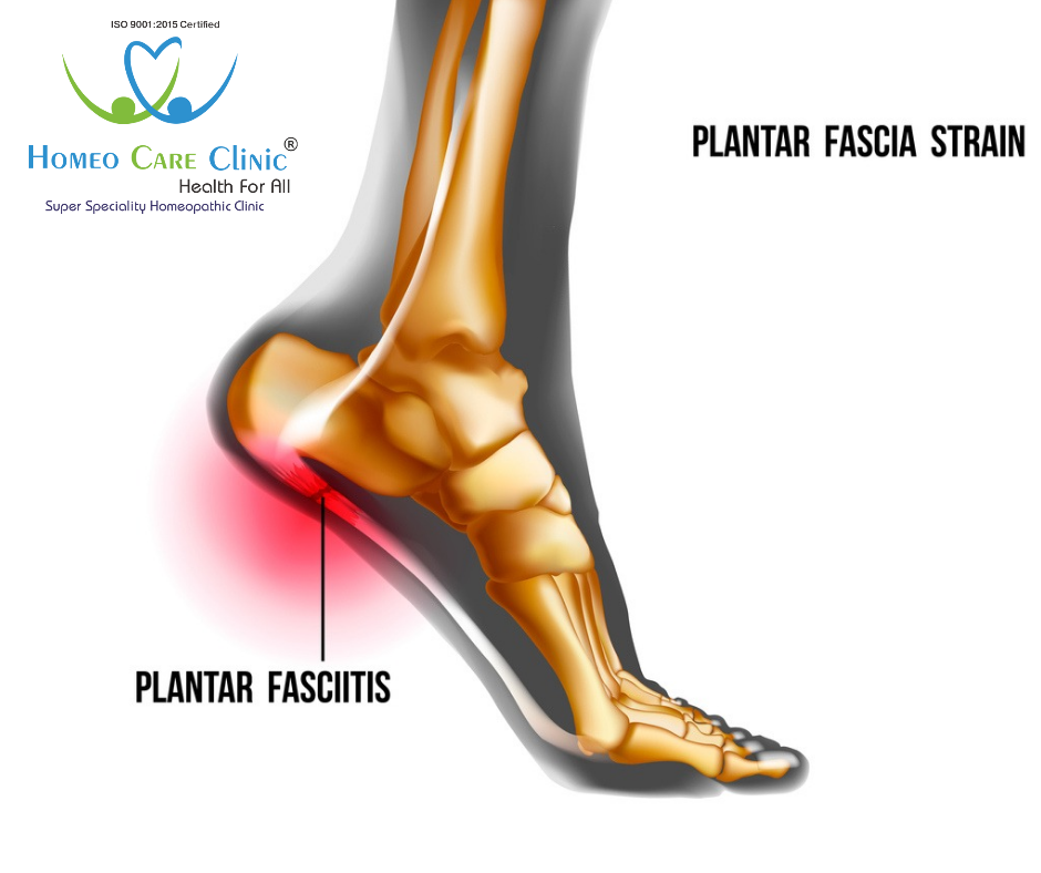 Causes of Planter fasciitis