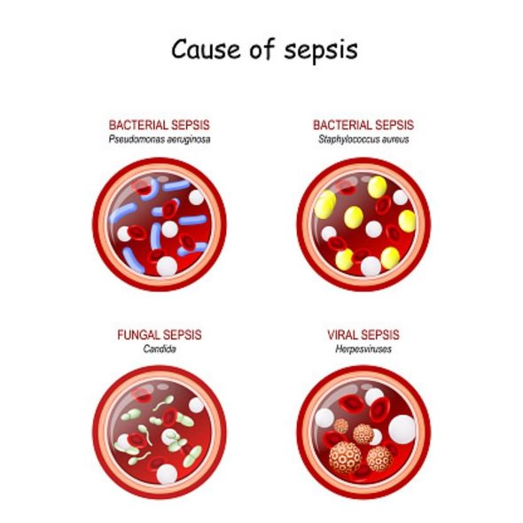 Causes of Septicemia