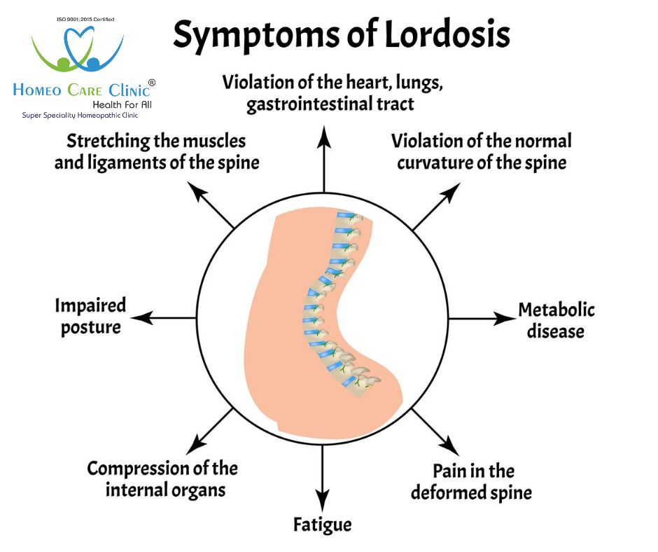 Lumbar Lordosis Symptom