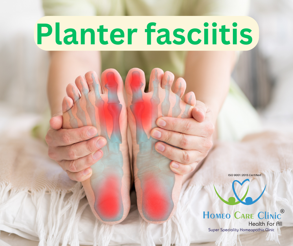 Plantar Fasciitis Homeopathy Treatment