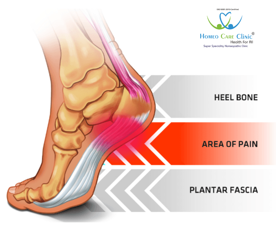 overweight plantar fasciitis 