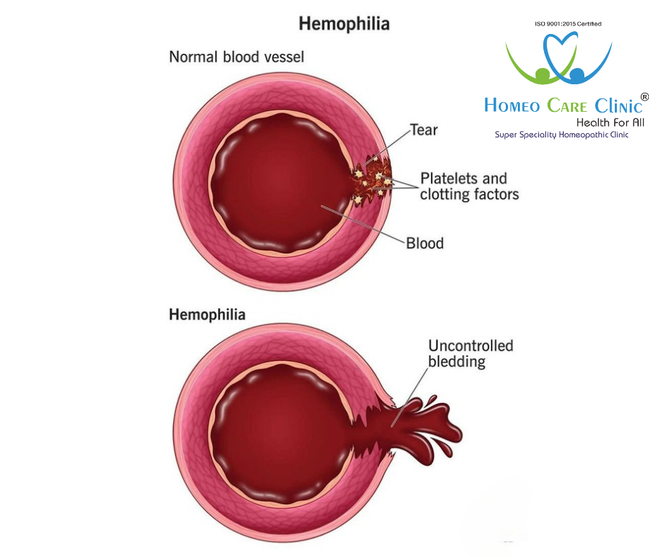 Hemophilia Incidence 