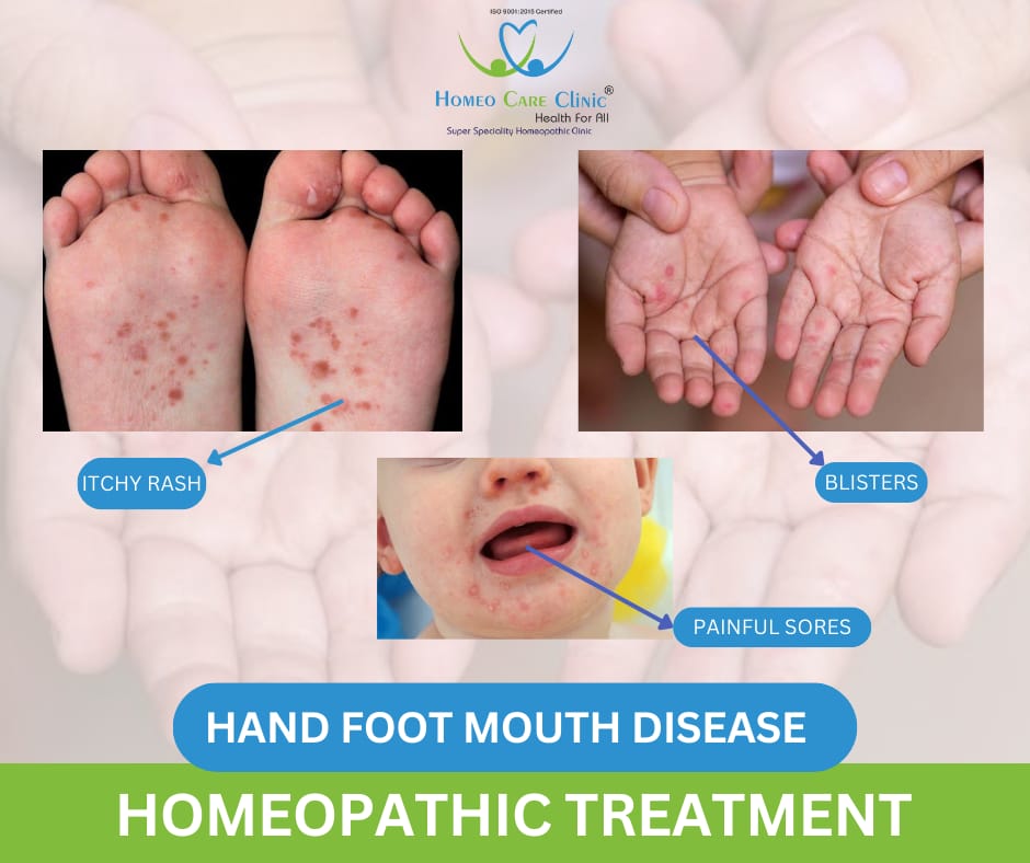 HFMD homeopathic medicine for children