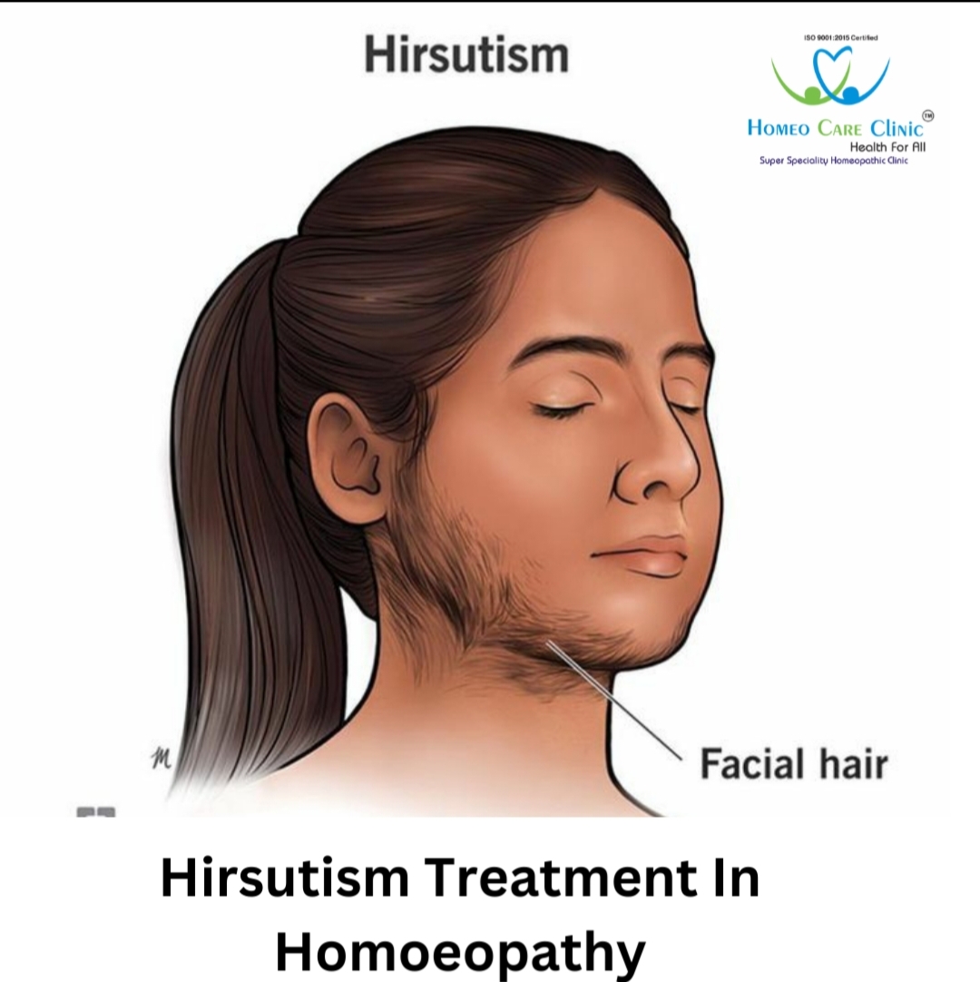 Homeopathy treatment for hirsutism