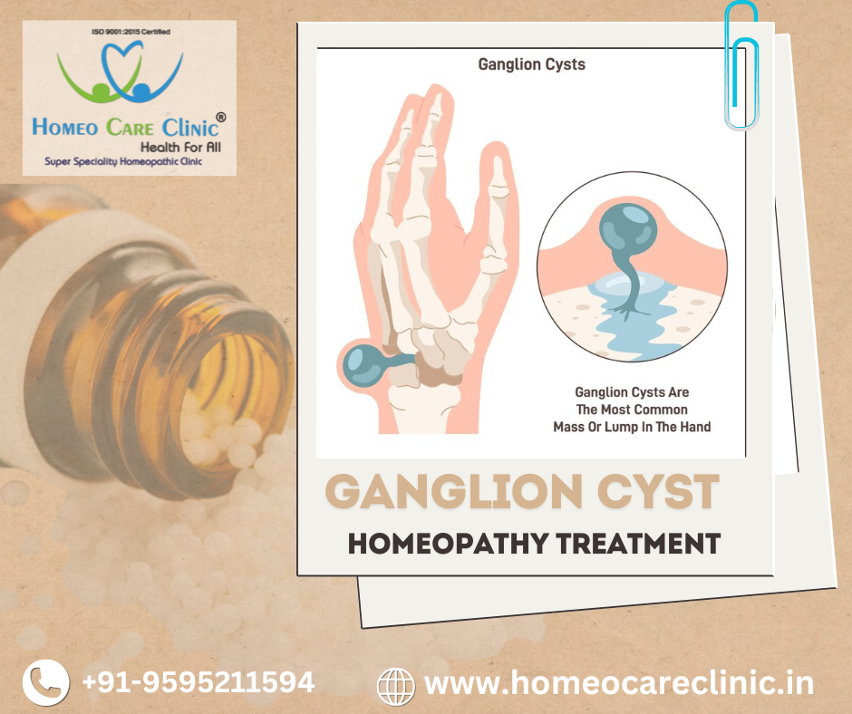 Homeopathic remedies for ganglion cysts