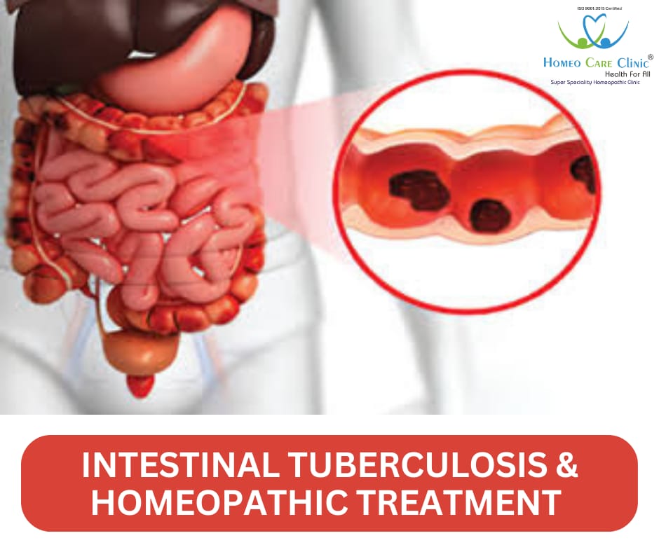 Homeopathic remedies for intestinal tuberculosis