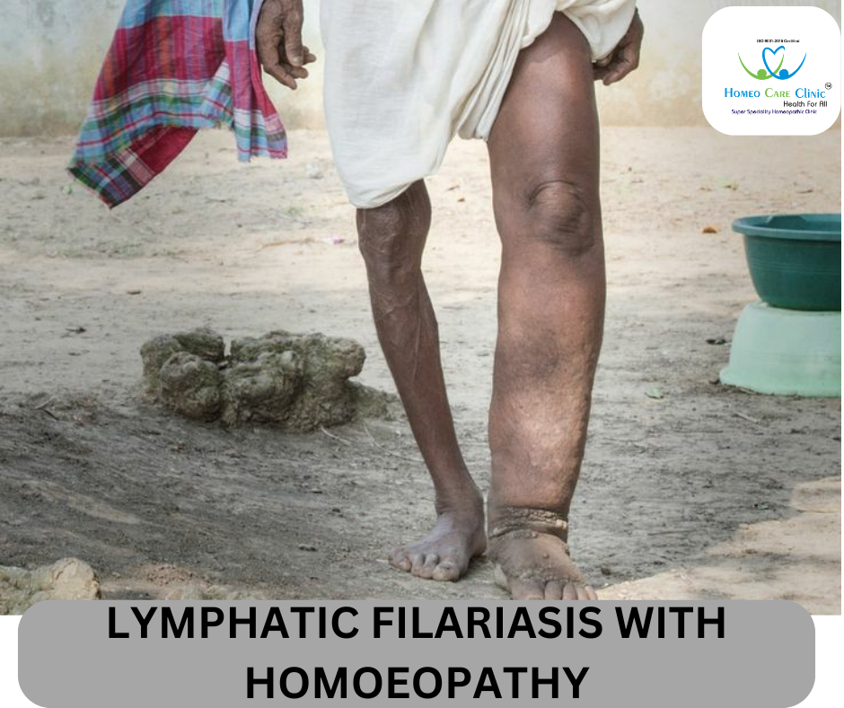 Causes and Symptoms of Lymphatic Filariasis