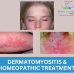 Homeopathic remedies for Dermatomyositis