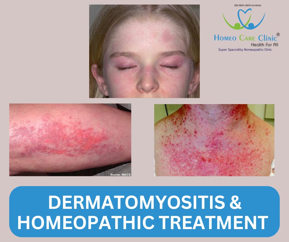 Homeopathic remedies for Dermatomyositis