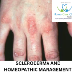 scleroderma Image