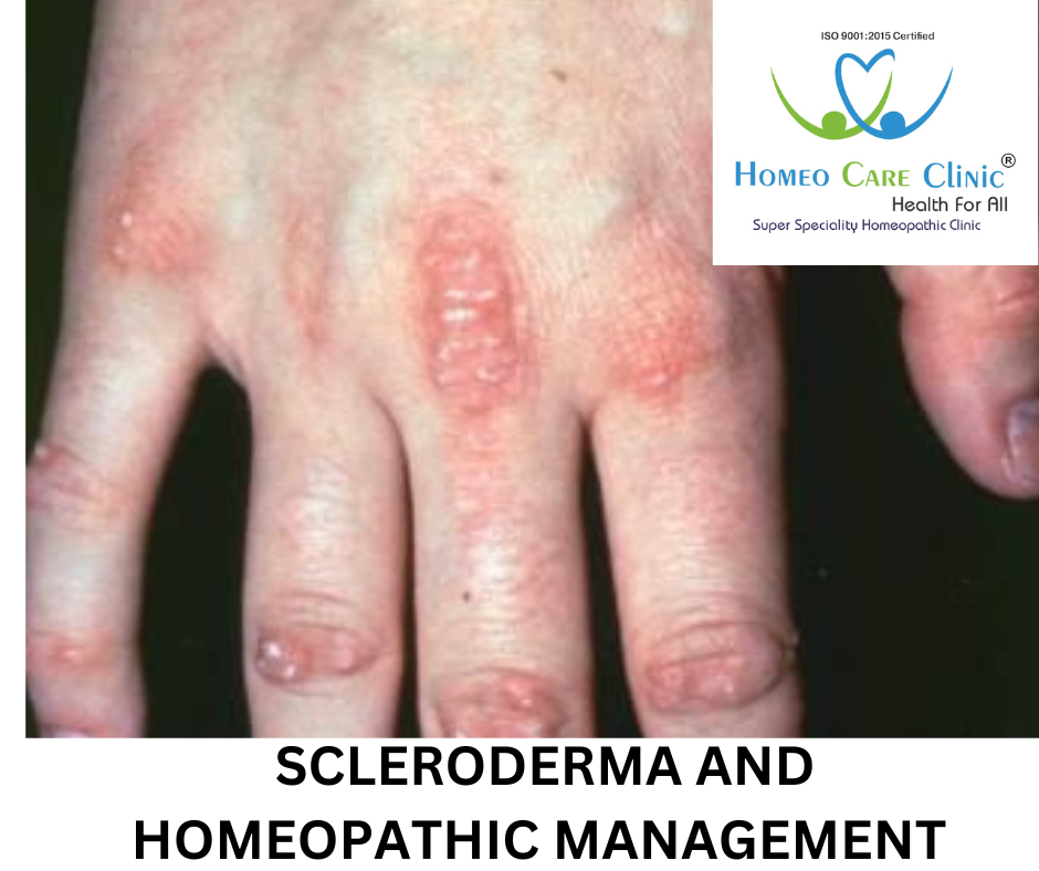 scleroderma Image