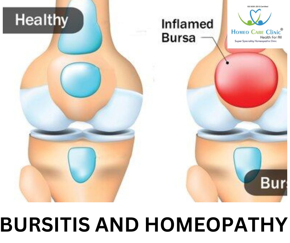 bursitis symptoms and treatment