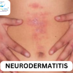 Homeopathic treatment for neurodermatitis