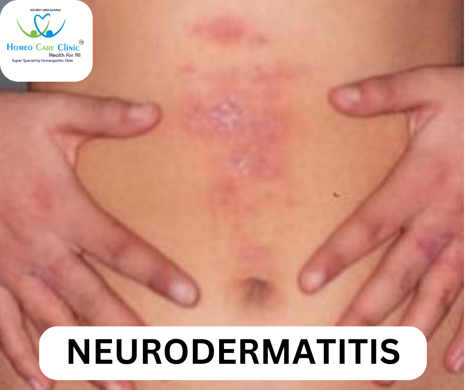 Homeopathic treatment for neurodermatitis