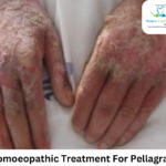 Homeopathic remedies for pellagra