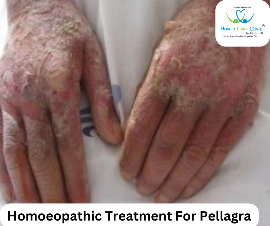 Homeopathic remedies for pellagra