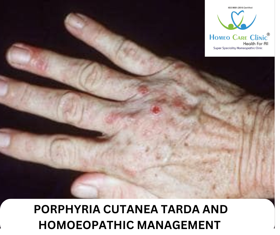 Porphyria Cutanea Tarda (PCT)