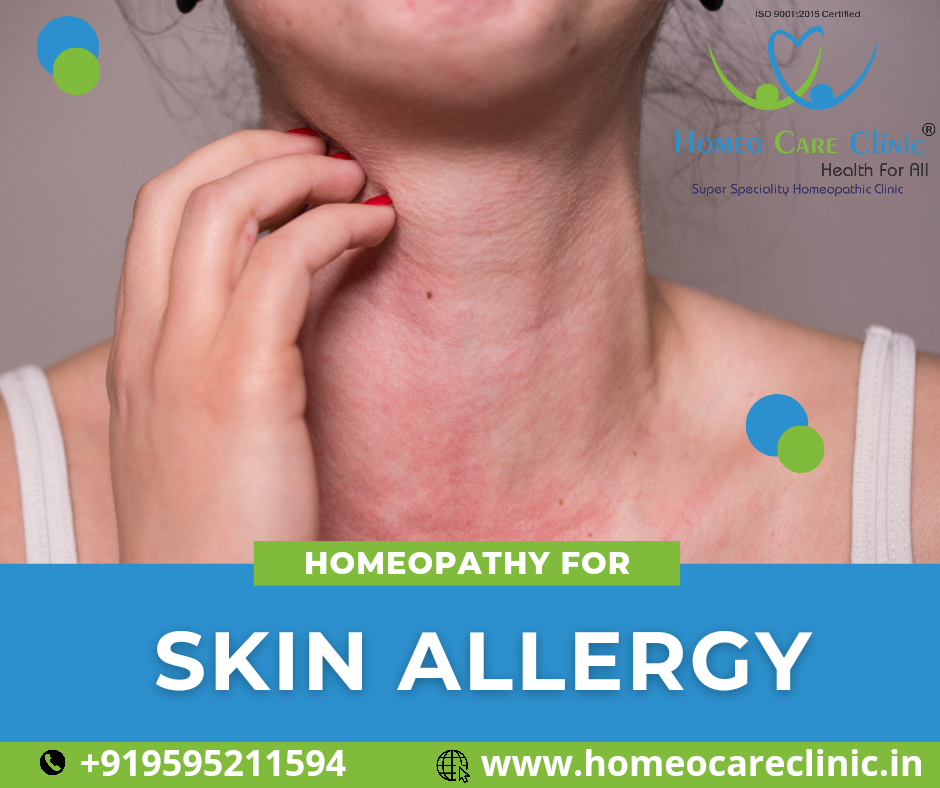 Homeopathic remedies for skin allergies